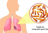 Thủ tướng chỉ đạo tăng cường công tác phòng, chống bệnh Lao