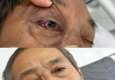 Thường xuyên bị đỏ mắt và ù tai, người đàn ông nhập viện trong tình trạng hôn mê sâu, phổi rất xấu