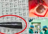 Ruột bút chì xuyên thủng nhãn cầu mắt của bé trai 9 tháng tuổi ở Nghệ An