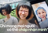 Bị mọi người xa lánh vì ngoại hình, người phụ nữ ở TP.HCM rớt nước mắt nói về khao khát hòa nhập cộng đồng