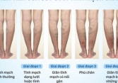 Tầm soát - phòng ngừa - cải thiện tình trạng “Suy giãn tĩnh mạch”