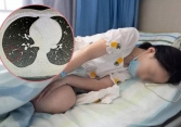 Cô gái trị mồ hôi tay lại vô tình phát hiện ung thư phổi, bác sĩ nhắc nhở những thói quen sinh hoạt của người trẻ