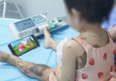 Bị đổ cả chai nước thông cống lên người, bé gái 25 tháng tuổi bỏng nặng