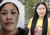 Hành trình lột xác từ 'mặt đen tối sầm' thành 'mặt hoa da phấn' của người phụ nữ 40 tuổi sau 3 năm từ Điện Biên về Hà Nội