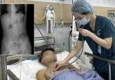 5 giờ phẫu thuật cho thiếu niên 15 tuổi bị cành cây đâm xuyên vùng hậu môn khi nhảy xuống ao tắm