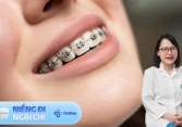 Niềng răng giúp giảm cân, liệu '1 mũi tên có trúng 2 đích'?