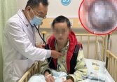 Cậu bé 13 tuổi nhiễm trùng phổi tái phát suốt 4 năm vì một chiếc vỏ 'kẹt' bên trong