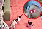 'Sốc' với hình ảnh vết răng đỏ chi chít trên mông em bé ở lớp mầm non: Trẻ bị bạn cắn nguy hiểm thế nào?