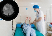 Đau đầu 5 ngày, người phụ nữ ở Phú Thọ bỗng ngã lăn ra đất, có giật, khó nói