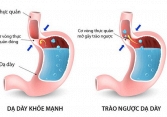 Đừng để GERD âm thầm tấn công sức khỏe bạn