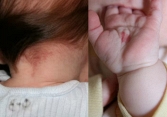 Em bé có bớt đỏ trên người: Dấu hiệu cho thấy con sinh ra với một “vết son” đặc biệt