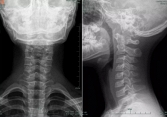 10 tuổi cột sống cổ đã cong vẹo, không cử động được vì thói quen của nhiều người