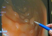 Polyp ở 3 vùng dễ dẫn đến ung thư, 5 thói quen tốt cần làm để tránh