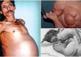 Người đàn ông mang trong mình 'thai chết lưu' suốt 36 năm, bào thai nặng 4kg, có cả tóc và tay chân 