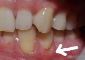 Răng vỡ rụng từng mảng vì cách đánh răng sai nhiều người mắc