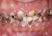 Cô gái mới 22 tuổi cả hàm răng đã đen kịt, ăn đồ mềm cũng rụng răng vì loại đồ uống người trẻ yêu thích