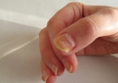 Người thiếu sắt nhìn vào móng tay thấy ngay 3 điểm, hãy mau tự kiểm tra