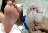 Bàn chân chàng trai lở loét trắng xóa, bốc mùi cá thối vì 1 hành vi khi đi giày rất nhiều người mắc phải