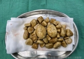 Lấy ra hơn 3kg sỏi từ bàng quang người đàn ông, nguyên nhân từ 'cái lười' tưởng vô hại của nhiều người