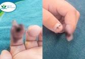 Bé gái 3 tuổi ở Hà Nội bị đứt rời búp ngón tay do kẹp vào cửa kính thuỷ lực ở siêu thị