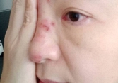 Mở gói hàng đặt qua mạng, người phụ nữ bị nhiễm trùng mắt