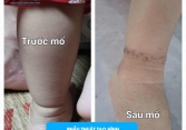 Phú Thọ: Bé gái 16 tháng tuổi có ngấn trên chân, bố mẹ tưởng bụ bẫm nhưng hoá ra lại là dị tật bẩm sinh nguy hiểm