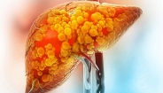 Vitamin B3, 'chìa khóa' trong điều trị gan nhiễm mỡ