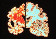 Phát hiện mới trong nghiên cứu điều trị Alzheimer bằng từ trường