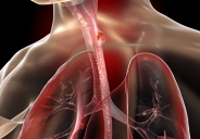 Công nghệ nội soi mới giúp phát hiện sớm ung thư thực quản với độ chính xác cao