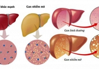 Cần làm gì khi bị gan nhiễm mỡ?