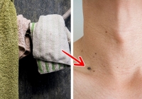 6 cách ngăn ngừa mụn cóc hiệu quả, bạn nên thử