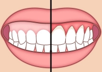Áp dụng 6 thói quen này để bảo vệ sức khỏe răng miệng