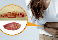 Số người nhập viện do sán lá gan tăng cao bất thường