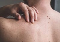 Ung thư da - Khối u ác tính giết chết nhiều đàn ông hơn phụ nữ