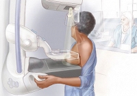 Mỹ khuyến nghị phụ nữ độ tuổi 40 nên tầm soát ung thư vú định kỳ