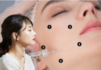 Những điều cần biết về tiêm BAP đang làm mưa làm gió mùa hè này