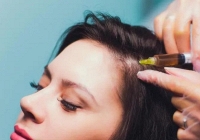 Tạm biệt nỗi lo rụng tóc với liệu pháp mesotherapy