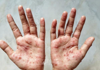 TP.HCM thông tin về hai trường hợp mắc bệnh đậu mùa khỉ