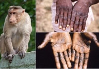 Không chủ quan với bệnh đậu mùa khỉ