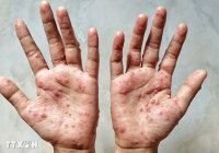 Phát hiện dạng đậu mùa khỉ mới dễ lây, có thể khiến 10% người bệnh tử vong