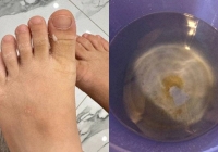 Nước sạch ở khu đô thị Thanh Hà gây mẩn ngứa: Chuyên gia nói về loại độc tố nguy hiểm đến sức khỏe