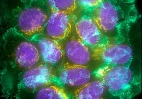 Ung thư giai đoạn 0 là gì? 