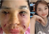 Cô gái xinh đẹp mặt biến dạng, chi chít lỗ mủ do tiêm mỡ tự thân làm đẹp