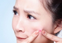 Mẹo chăm sóc da đúng cách sau khi nặn mụn