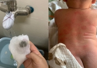 Sở Xây dựng Hà Nội lên tiếng vụ hàng trăm cư dân nổi mẩn ngứa, bong tróc da khi dùng nước sinh hoạt