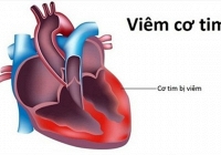 Thực hư virus viêm cơ tim gây chết người đang xôn xao cộng đồng mạng
