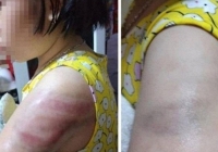 Vụ học sinh bị đánh bầm tím tay vì viết bài chậm: Cô giáo tường trình do mất bình tĩnh
