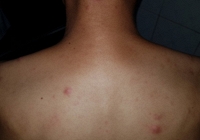 Tái xuất hiện bệnh phong cùi