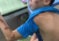 Cậu bé 14 tuổi bị chủ quán bánh xèo ở Bắc Ninh bạo hành dã man