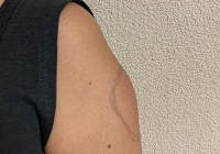 ‘Cánh tay COVID’ – tác dụng phụ hiếm gặp sau tiêm vaccine COVID-19